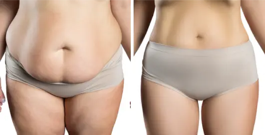 The Science of Body Contouring: Understanding Liposuction and Tummy Tucks