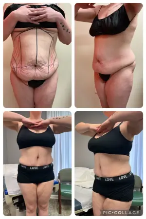 tummy tuck