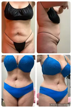 tummy tuck