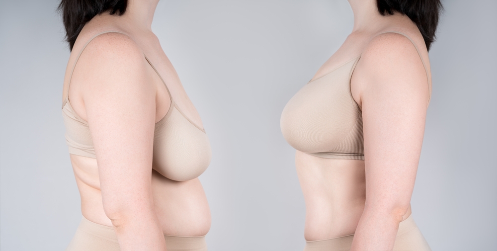 Enhance Your Shape with a Breast Lift + Augmentation